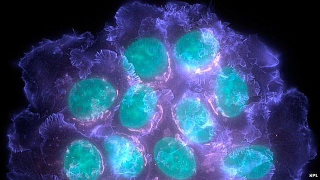 _83251051_m1220418-breast_cancer_cells,_light_micrograph-spl.jpg