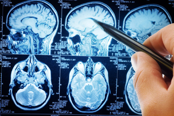 What You Need to Know About Brain Cancer