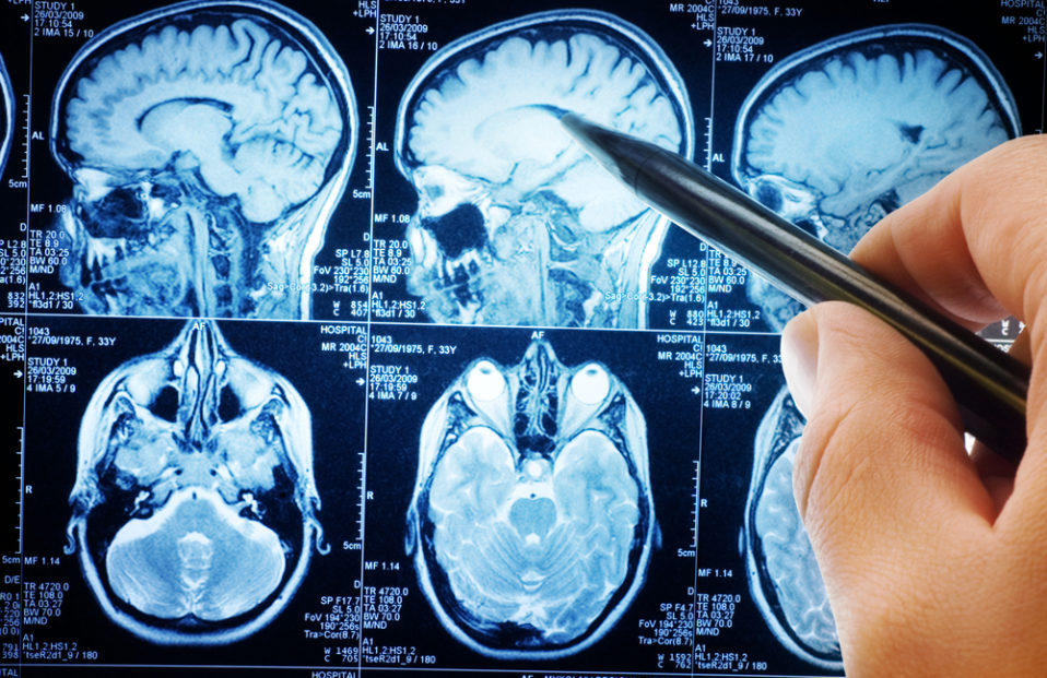 What You Need to Know About Brain Cancer