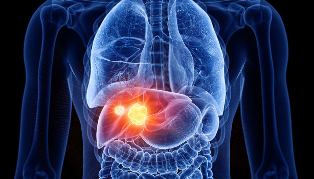 liver-cancer-where-we-are-now-asian-fund-for-cancer-research