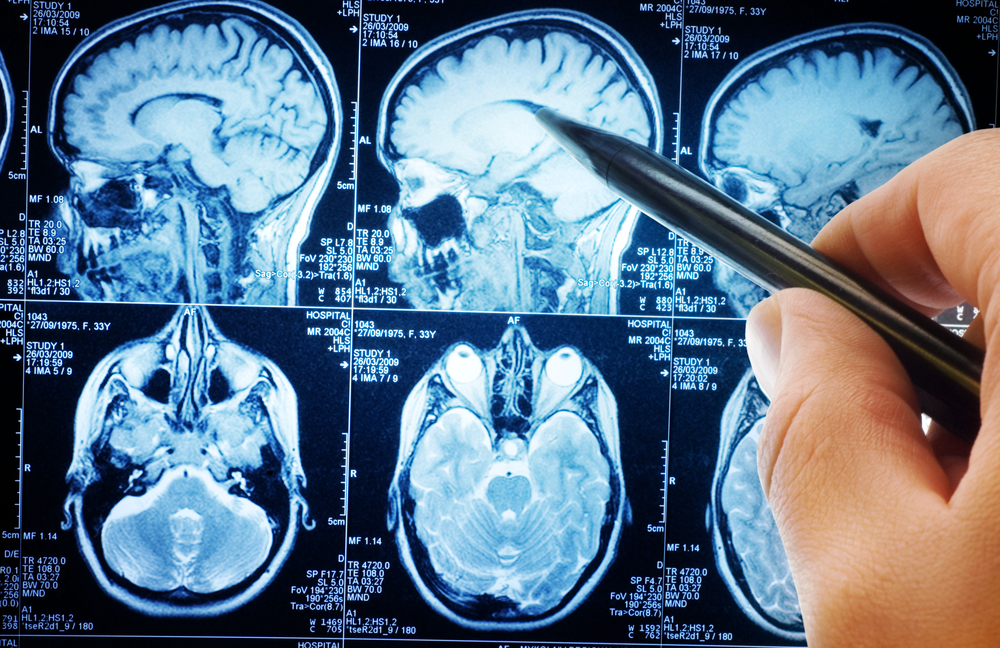 what-you-need-to-know-about-brain-cancer-afcr